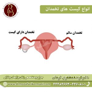 انواع کیست تخمدان