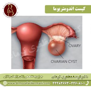 کیست اندومتریوما
