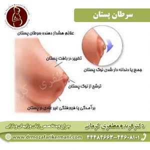 سرطان پستان